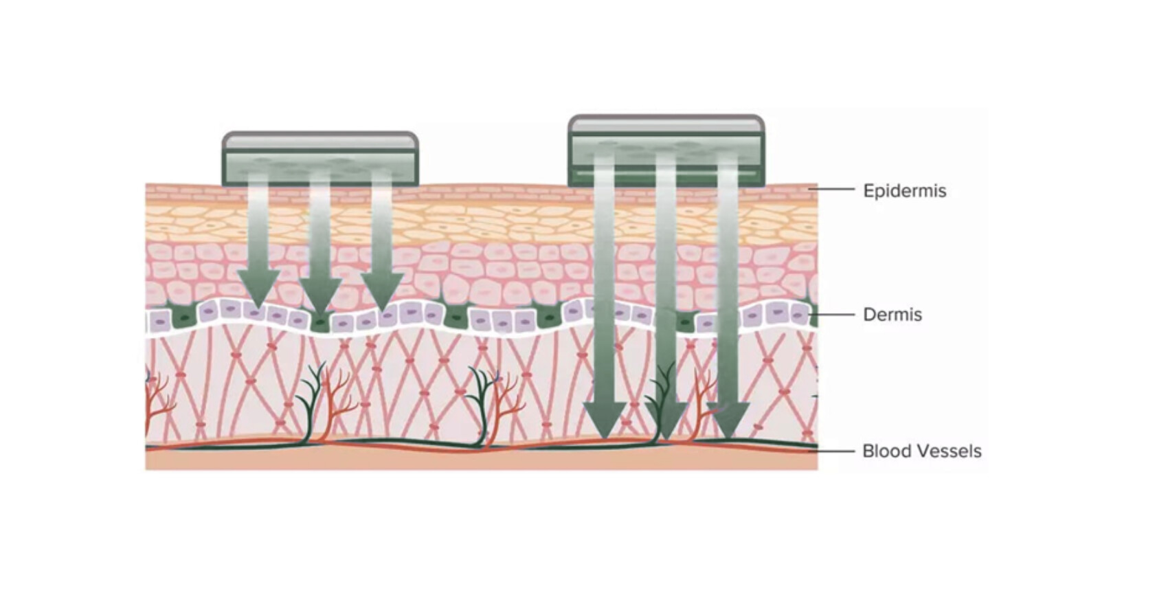 Graphic showing construction of Human Skin (Epidermis)